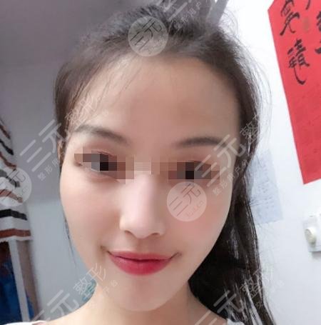 上海葛志鑫隆鼻后5周