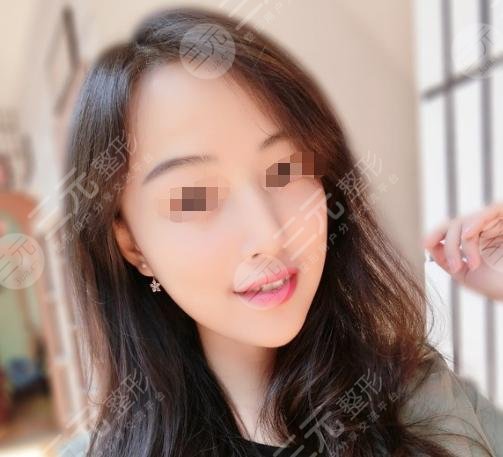 上海葛志鑫隆鼻后12周