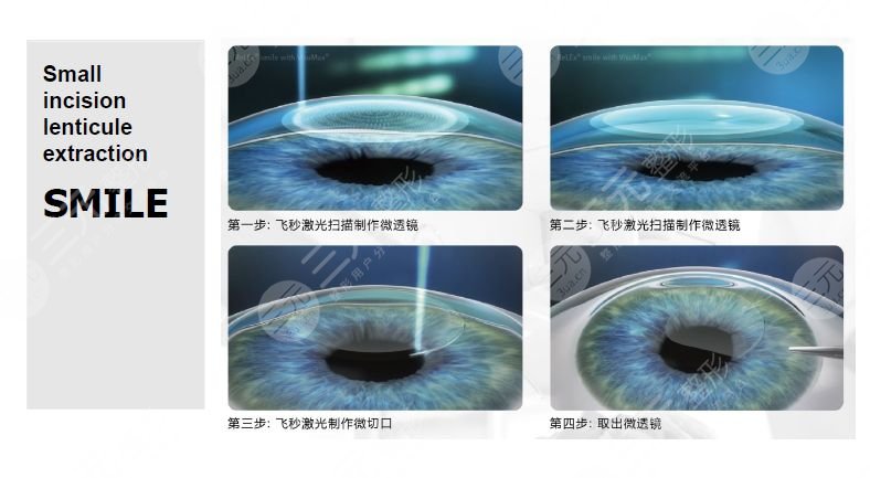 深圳近视手术可以用社保卡吗