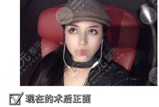 上海夏亦菲医院隆鼻整形后
