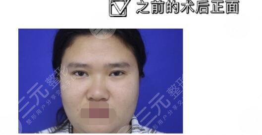 上海夏亦菲医院隆鼻整形前