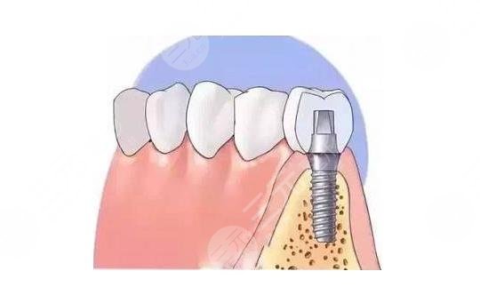 北大口腔医院种植牙一颗多少钱