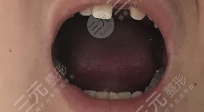 北大口腔医院种植牙案例