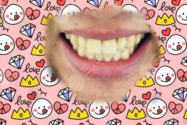 北大口腔医院种植牙案例