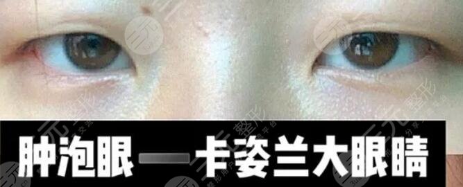 厦门第一医院整形科双眼皮术前