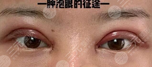厦门第一医院整形科双眼皮术后一周
