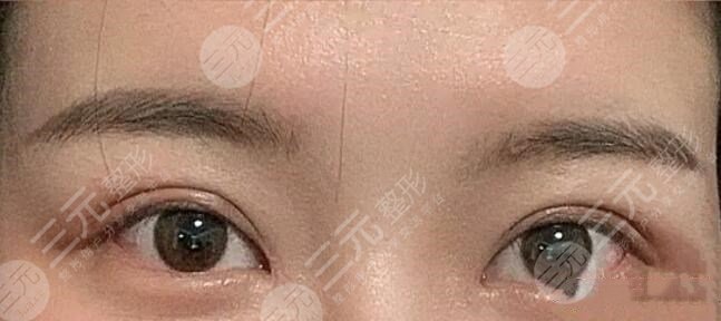 厦门第一医院整形科双眼皮术后果
