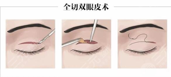 全切式双眼皮