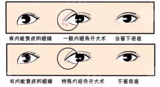 开眼角