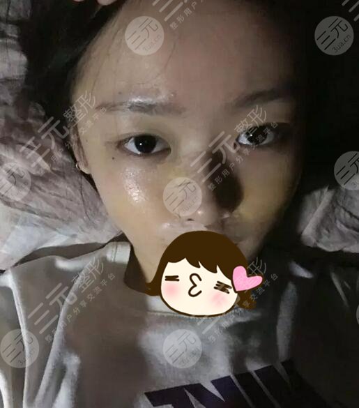 西安西京医院整形科假体隆鼻案例