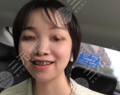 西京医院整形鼻头缩小前