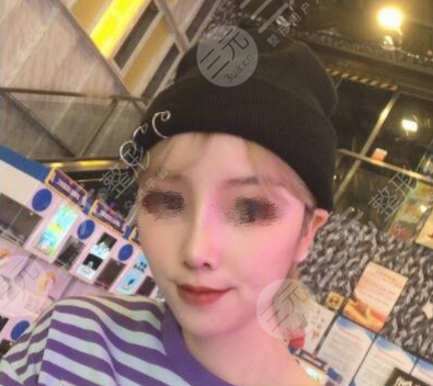 西京医院整形鼻头缩小后3周
