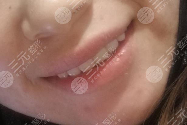 美奥口腔医院牙齿贴片经历分享