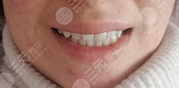 美奥口腔医院牙齿贴片经历分享