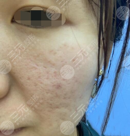 四川大学华西整形美容痘疤治疗前