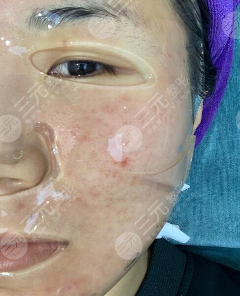 四川大学华西整形美容痘疤治疗后