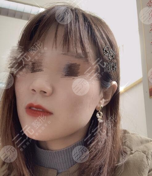 四川大学华西整形美容痘疤治疗后2个月