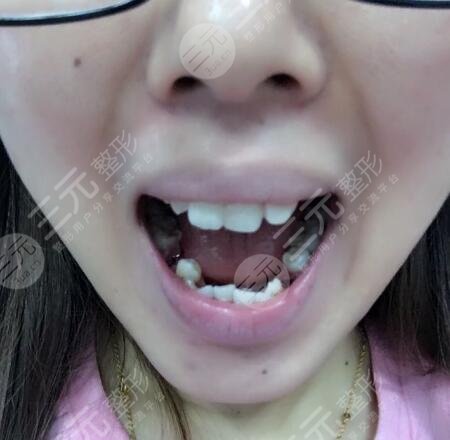 中南大学湘雅口腔医院牙齿正畸前