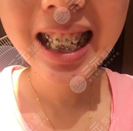 光华口腔医院牙齿矫正案例