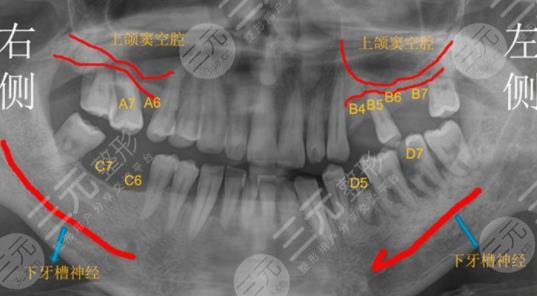 浙江大学医学院附属口腔医院种植牙经历分享