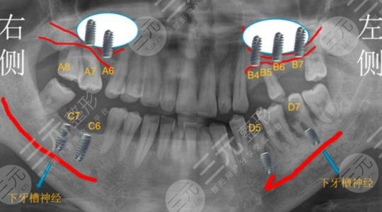 浙江大学医学院附属口腔医院种植牙经历分享