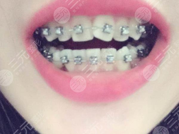 浙江省口腔医院牙齿矫正经历分享
