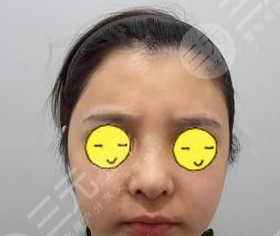 四川大学华西整形美容面部吸脂前