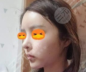 四川大学华西整形美容面部吸脂后一周