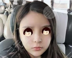 四川大学华西整形美容面部吸脂后3周