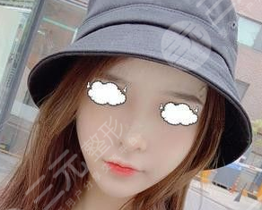 四川大学华西整形美容面部吸脂9周