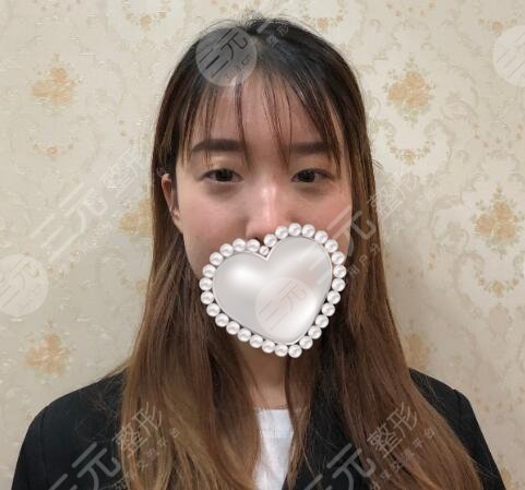 张姣姣双眼皮价格