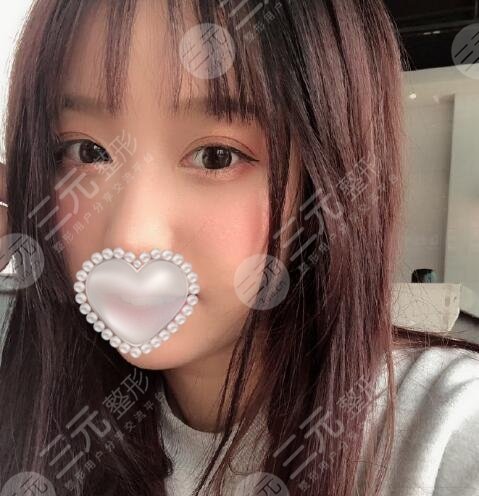 张姣姣双眼皮价格