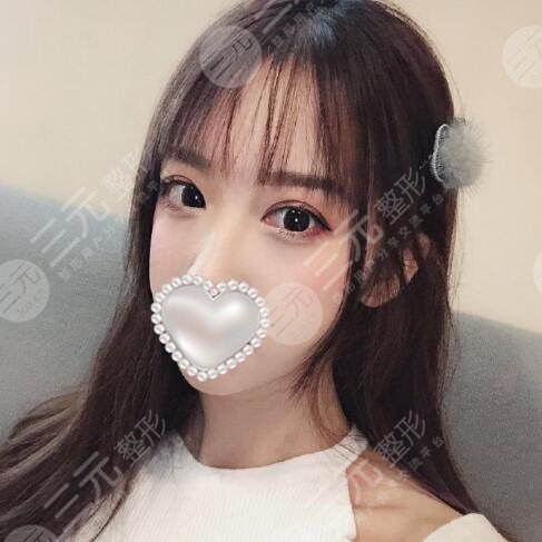张姣姣双眼皮价格