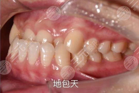 佛山市第一人民医院口腔科牙齿矫正分享