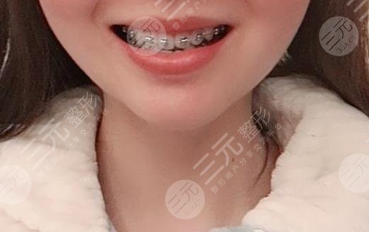 佛山市第一人民医院口腔科牙齿矫正分享