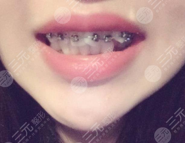 广元邓牙科牙齿矫正分享