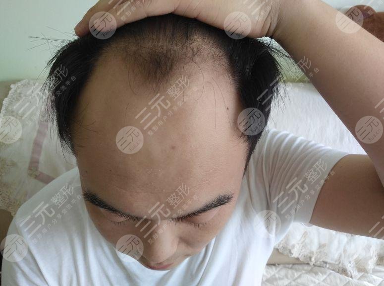 唐山煤医整形医院植发案例