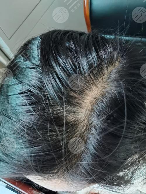 唐山煤医整形医院植发案例