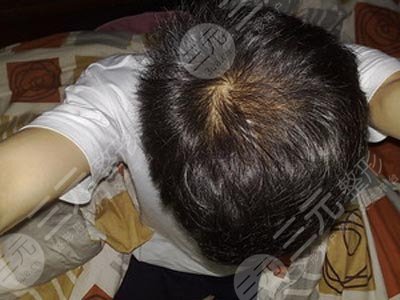 唐山煤医整形医院植发案例