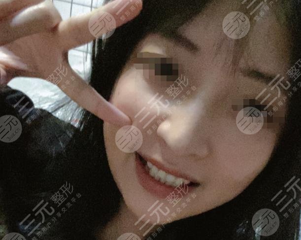 广元邓牙科牙齿矫正分享