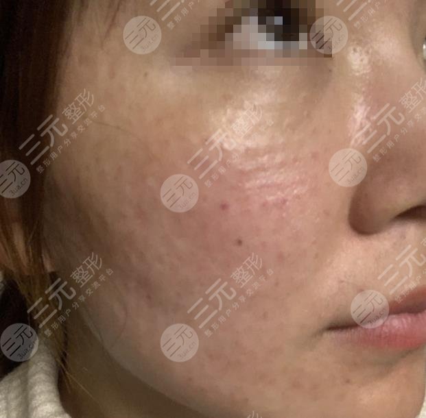 上海九院激光美容手术分享