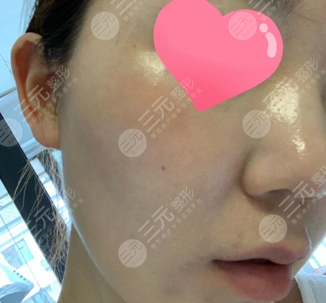 上海九院激光美容手术分享