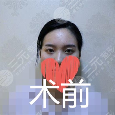 协和孙家明割双眼皮真实经历