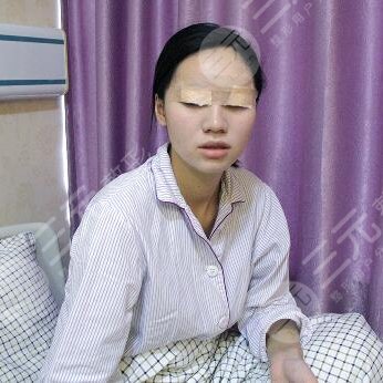 协和孙家明割双眼皮真实经历