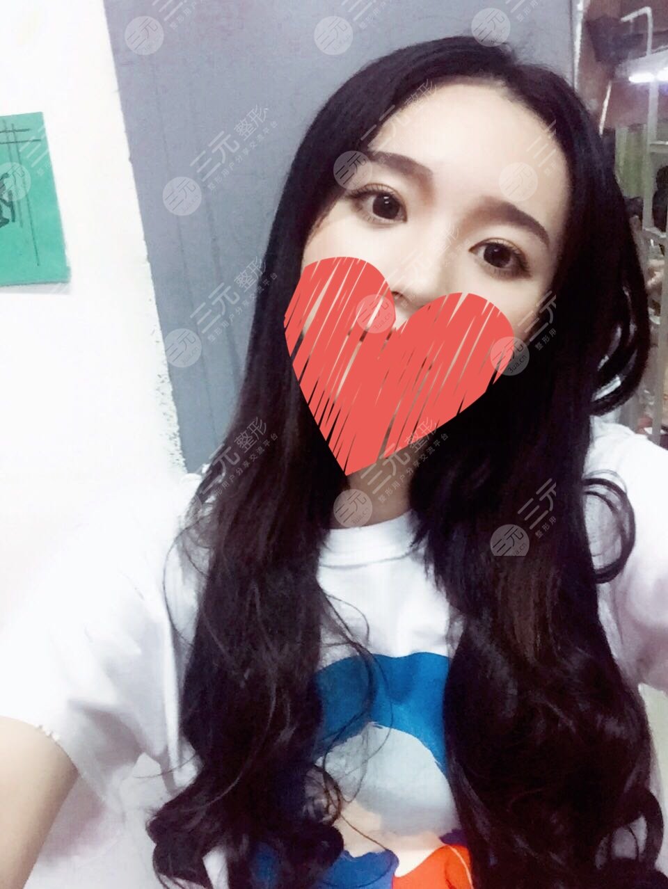 协和孙家明割双眼皮真实经历