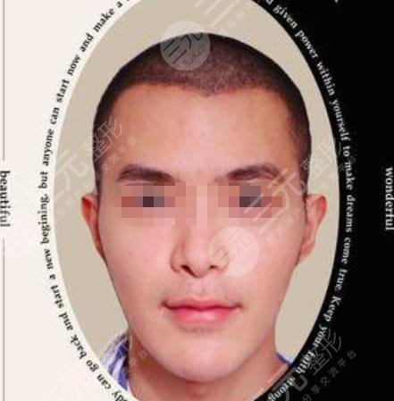华西医院整形科李正勇医生案例
