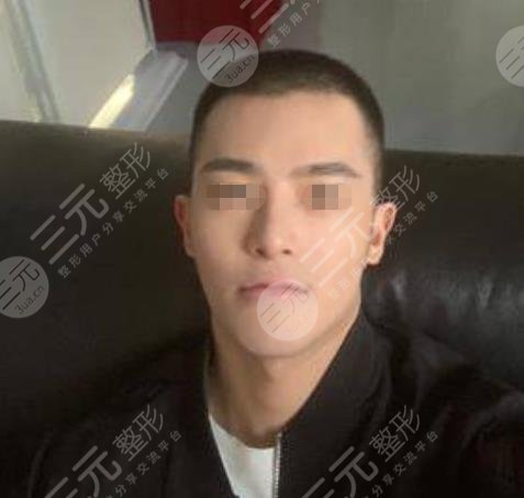 华西医院整形科李正勇医生案例