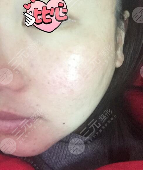 沈阳七院激光科太贵了？沈阳七院激光美容价目表2025来袭！