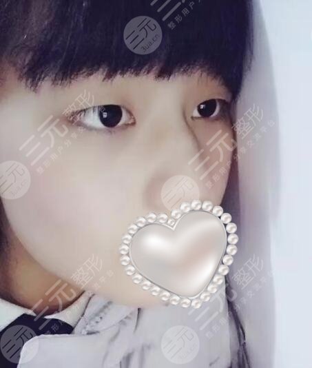 长治市医院整形美容科双眼皮案例