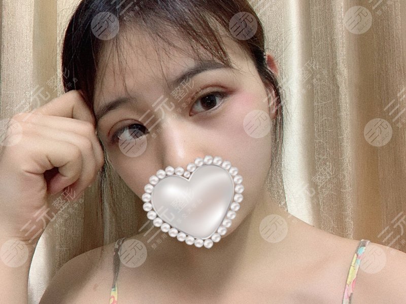 长治市医院整形美容科双眼皮案例